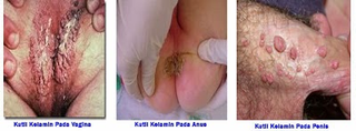 Illustration for article titled obat kutil di sekitar
kelamin